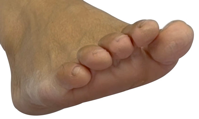 Silicone Toe Aligners